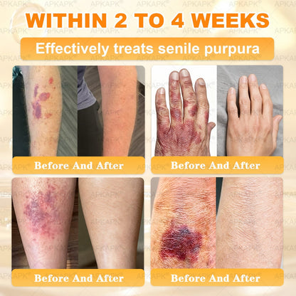 Official Store | 𝐀𝐏𝐊𝐀𝐏𝐊® 𝟖-𝐈𝐧-𝟏 𝐁𝐞𝐞 𝐕𝐞𝐧𝐨𝐦 & 𝐓𝐚𝐥𝐥𝐨𝐰 𝐒𝐤𝐢𝐧 𝐅𝐢𝐫𝐦𝐢𝐧𝐠 & 𝐓𝐫𝐞𝐚𝐭𝐦𝐞𝐧𝐭 𝐂𝐫𝐞𝐚𝐦 (Effective Within 7 Days)Bee Venom + Tallow · 7X Deep Hydration, targets wrinkles, sagging, stretch marks, dark spots, purpura, inflammations and more