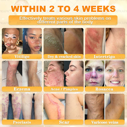 Official Store | 𝐀𝐏𝐊𝐀𝐏𝐊® 𝟖-𝐈𝐧-𝟏 𝐁𝐞𝐞 𝐕𝐞𝐧𝐨𝐦 & 𝐓𝐚𝐥𝐥𝐨𝐰 𝐒𝐤𝐢𝐧 𝐅𝐢𝐫𝐦𝐢𝐧𝐠 & 𝐓𝐫𝐞𝐚𝐭𝐦𝐞𝐧𝐭 𝐂𝐫𝐞𝐚𝐦 (Effective Within 7 Days)Bee Venom + Tallow · 7X Deep Hydration, targets wrinkles, sagging, stretch marks, dark spots, purpura, inflammations and more