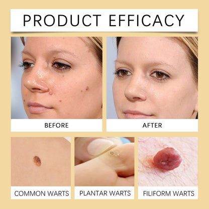 Pain-free Bee Venom Wart and Tags Removoal Cream